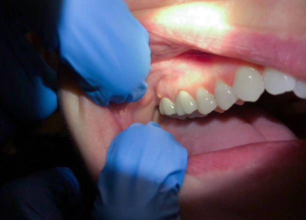 Best Emergency Broken Tooth Repair in Augusta, ME