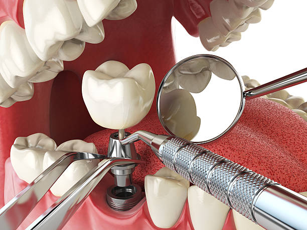 Best Emergency Wisdom Teeth Removal in Augusta, ME